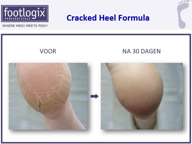 Footlogix Cracked Heel Formula tegen Ernstige Kloven 3+