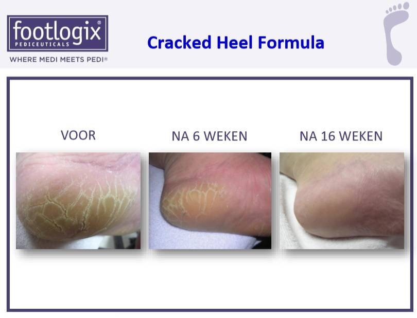 Footlogix Cracked Heel Formula tegen Ernstige Kloven 3+