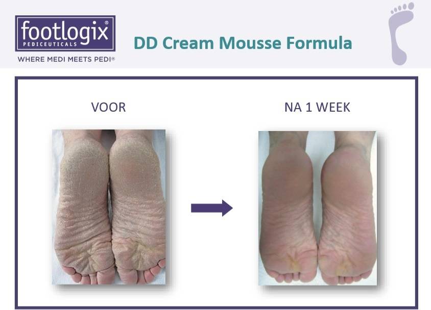 Footlogix DD Cream Mousse voor Hydratatie Nr. 1