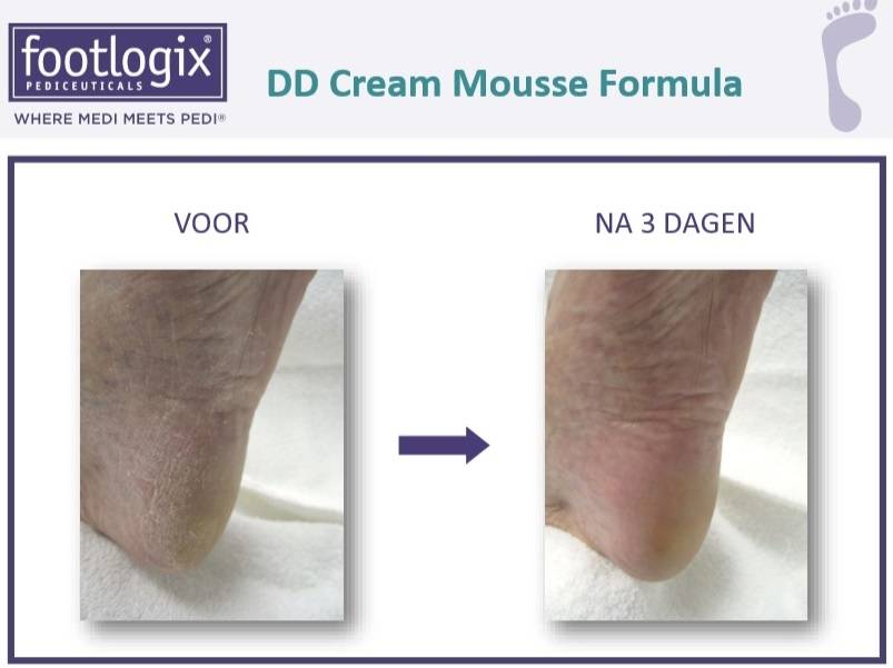 Footlogix DD Cream Mousse voor Hydratatie Nr. 1