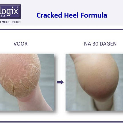 Footlogix Footlogix Cracked Heel Formula tegen Ernstige Kloven 3+