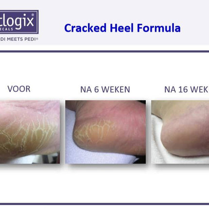 Footlogix Footlogix Cracked Heel Formula tegen Ernstige Kloven 3+