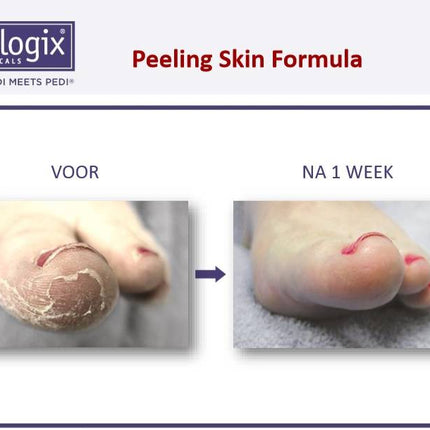 Footlogix Footlogix Peeling Skin Formula tegen Loskomend Huid nr.7
