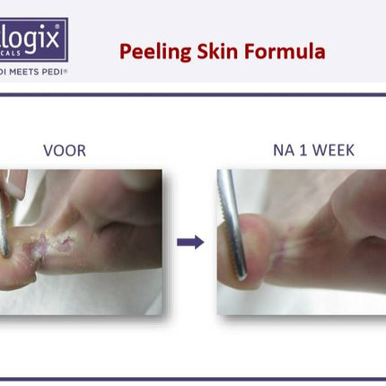 Footlogix Footlogix Peeling Skin Formula tegen Loskomend Huid nr.7