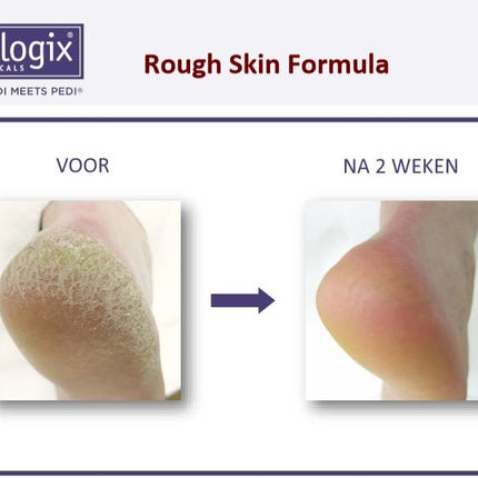 Footlogix Footlogix Rough Skin Formula tegen Droge, Ruwe Huid 7+