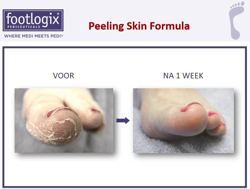 Footlogix Peeling Skin Formula tegen Loskomend Huid nr.7