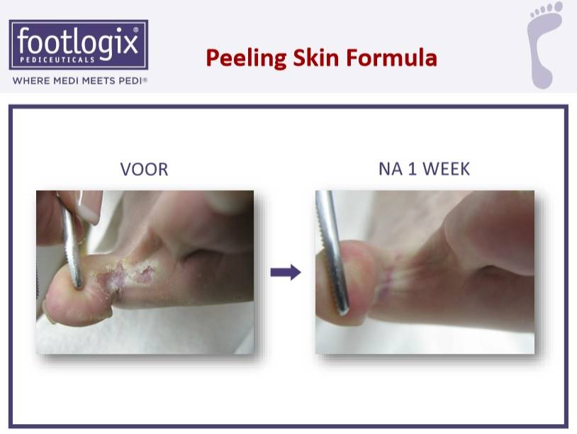 Footlogix Peeling Skin Formula tegen Loskomend Huid nr.7