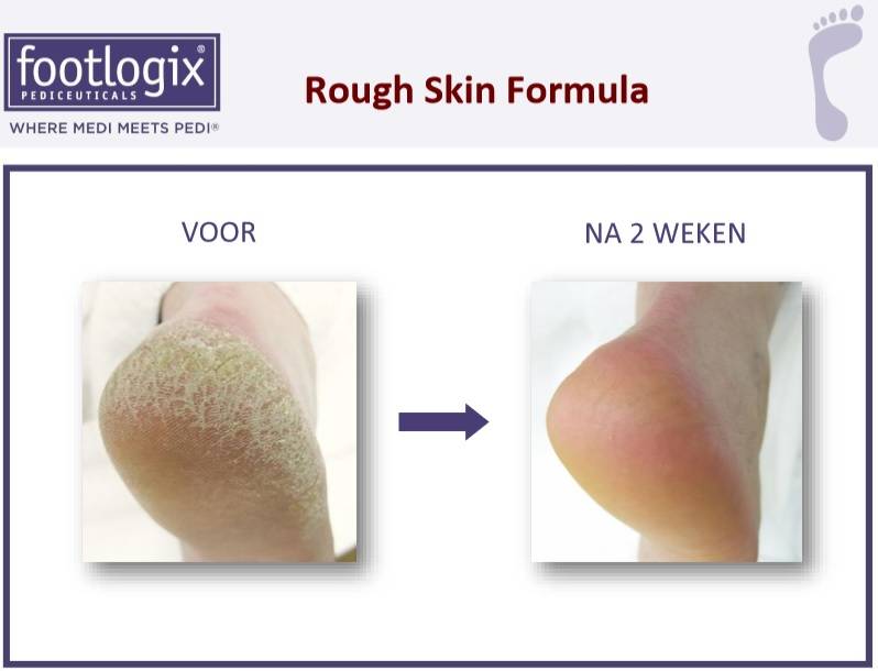 Footlogix Rough Skin Formula tegen Droge, Ruwe Huid 7+