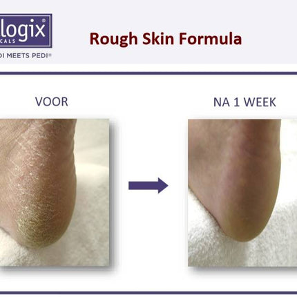 Footlogix Rough Skin Formula tegen Droge, Ruwe Huid 7+