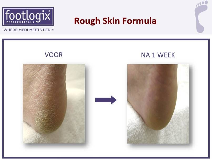 Footlogix Rough Skin Formula tegen Droge, Ruwe Huid 7+