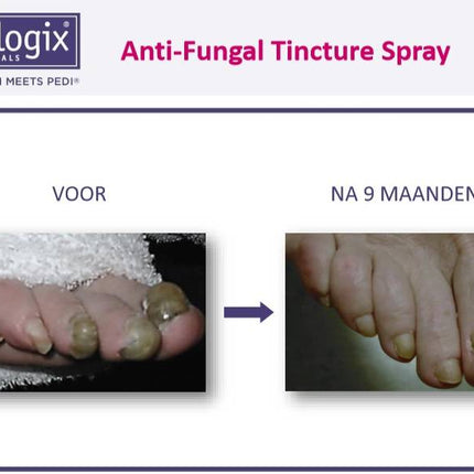 Footlogix Toe Nail Tincture Anti-Schimmel Teennagel Tinctuur Spray  nr 7T