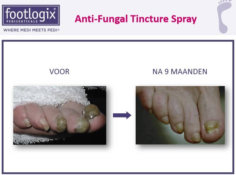 Footlogix Toe Nail Tincture Anti-Schimmel Teennagel Tinctuur Spray  nr 7T