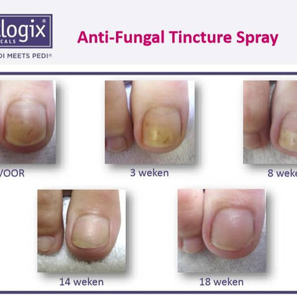 Footlogix Toe Nail Tincture Anti-Schimmel Teennagel Tinctuur Spray  nr 7T