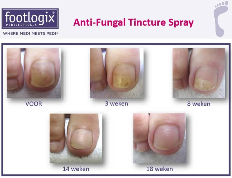 Footlogix Toe Nail Tincture Anti-Schimmel Teennagel Tinctuur Spray  nr 7T