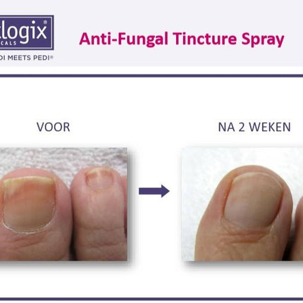 Footlogix Toe Nail Tincture Anti-Schimmel Teennagel Tinctuur Spray  nr 7T