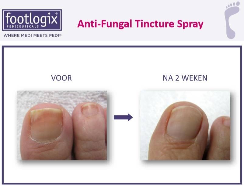 Footlogix Toe Nail Tincture Anti-Schimmel Teennagel Tinctuur Spray  nr 7T