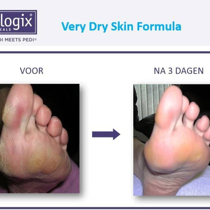 Footlogix Very Dry Skin Formula tegen Droge Huid 3