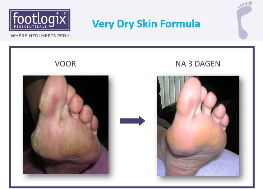 Footlogix Very Dry Skin Formula tegen Droge Huid 3