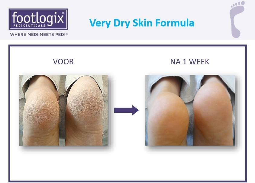 Footlogix Very Dry Skin Formula tegen Droge Huid 3