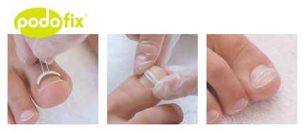 Kappershandel Podofix Nagelbeugels Spange Diverse Maten (8 Stuks)