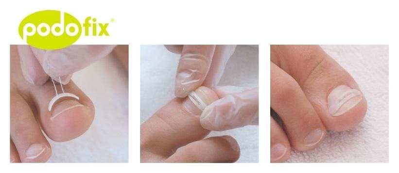 Kappershandel Podofix Nagelbeugels Spange Diverse Maten (8 Stuks)